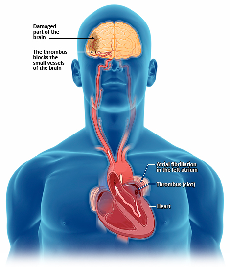 atrial fibrillation stroke